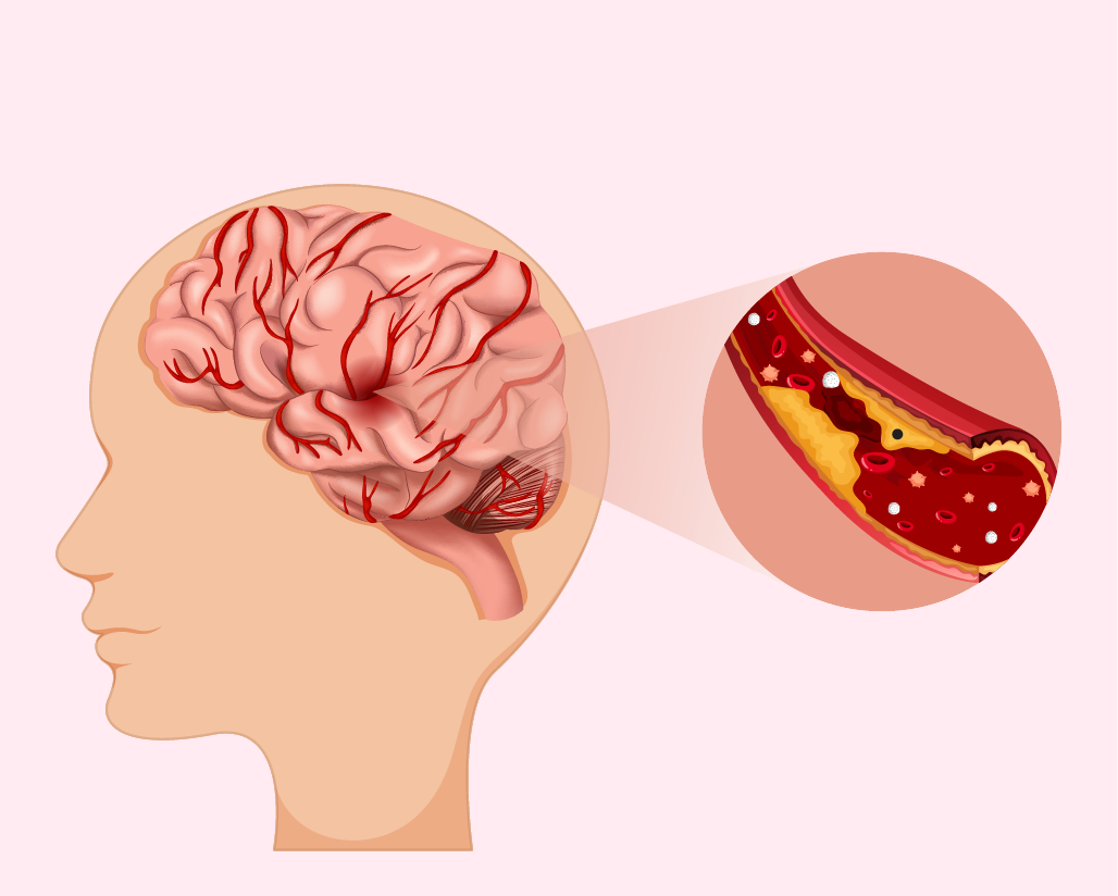 GÓI TẦM SOÁT NGUY CƠ ĐỘT QUỴ